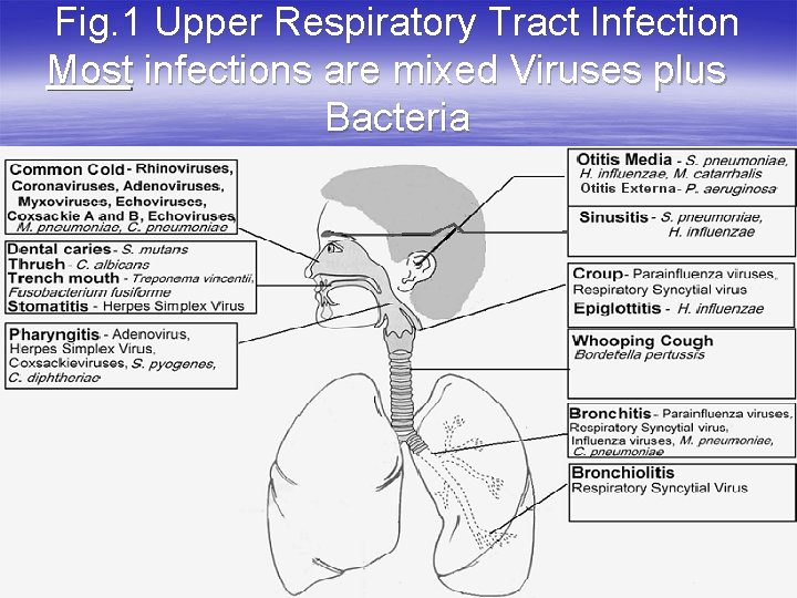 Fig. 1 Upper Respiratory Tract Infection Most infections are mixed Viruses plus Bacteria 