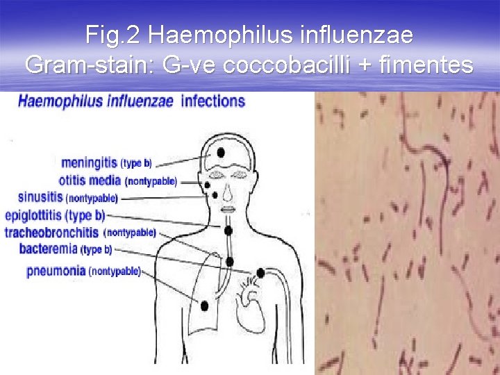 Fig. 2 Haemophilus influenzae Gram-stain: G-ve coccobacilli + fimentes 