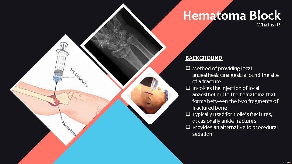 Hematoma Block What is it? BACKGROUND q Method of providing local anaesthesia/analgesia around the