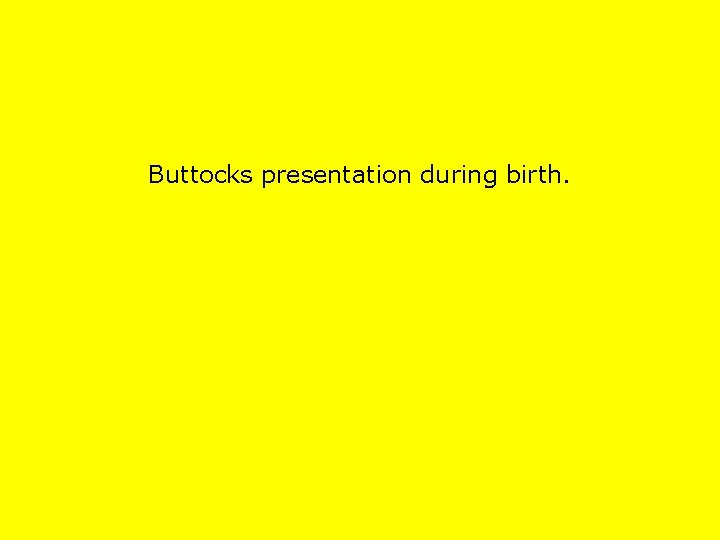 Buttocks presentation during birth. 