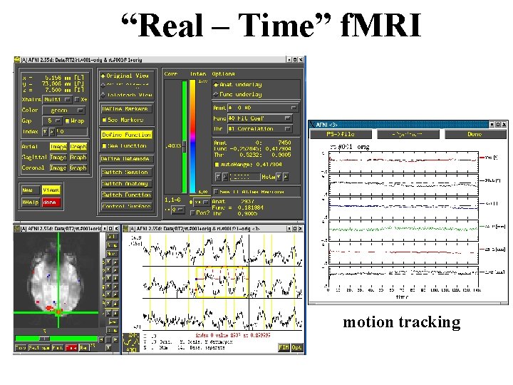 “Real – Time” f. MRI motion tracking 