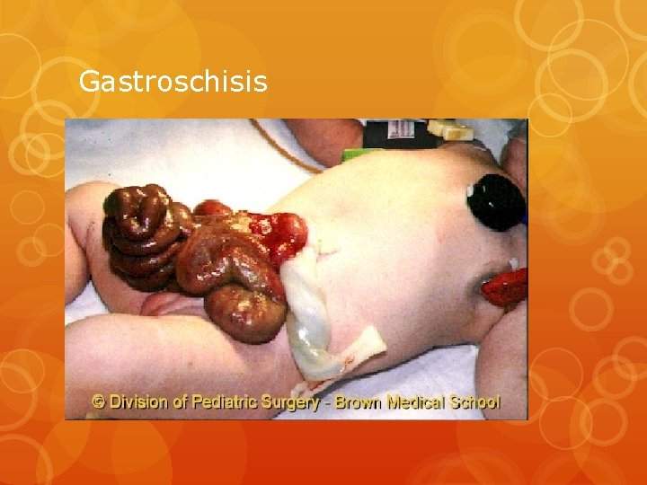 Gastroschisis 