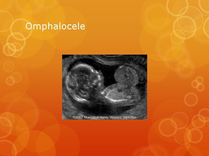 Omphalocele 