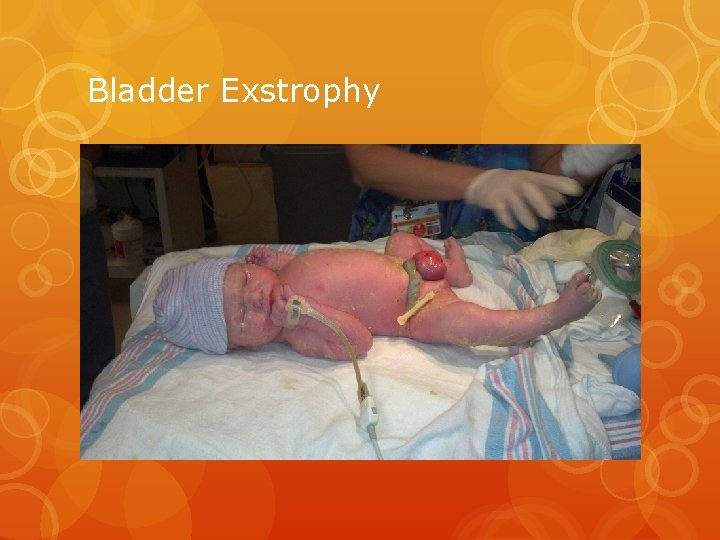 Bladder Exstrophy 