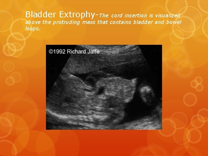 Bladder Extrophy-The cord insertion is visualized above the protruding mass that contains bladder and