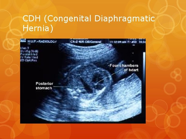 CDH (Congenital Diaphragmatic Hernia) 