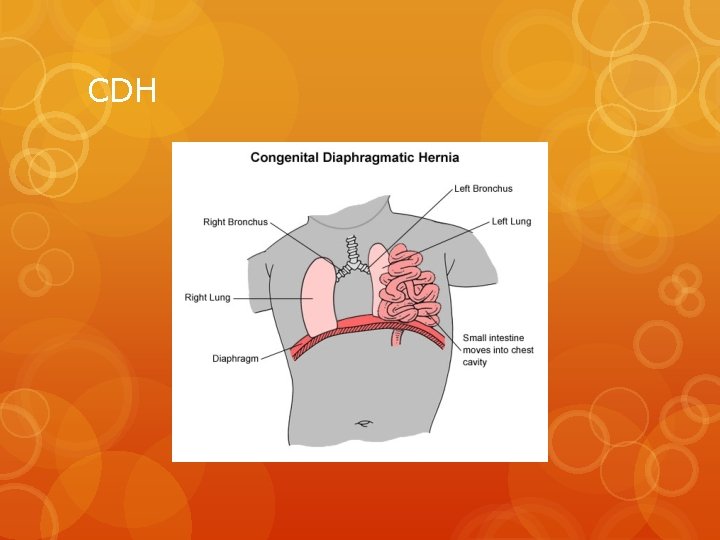 CDH 