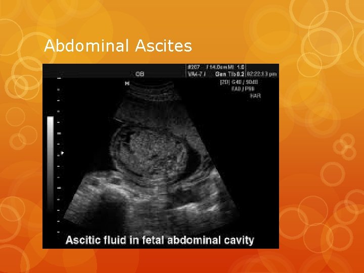 Abdominal Ascites 