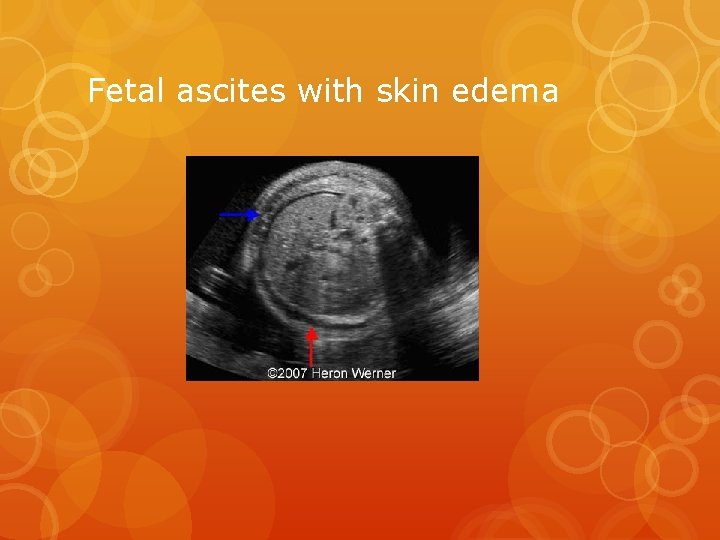 Fetal ascites with skin edema 