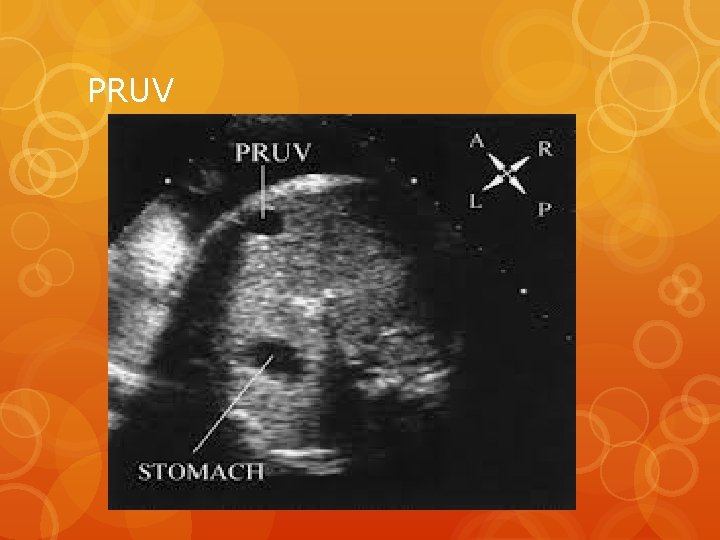 PRUV 
