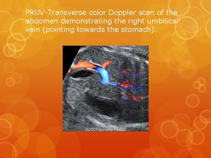 PRUV-Transverse color Doppler scan of the abdomen demonstrating the right umbilical vein (pointing towards