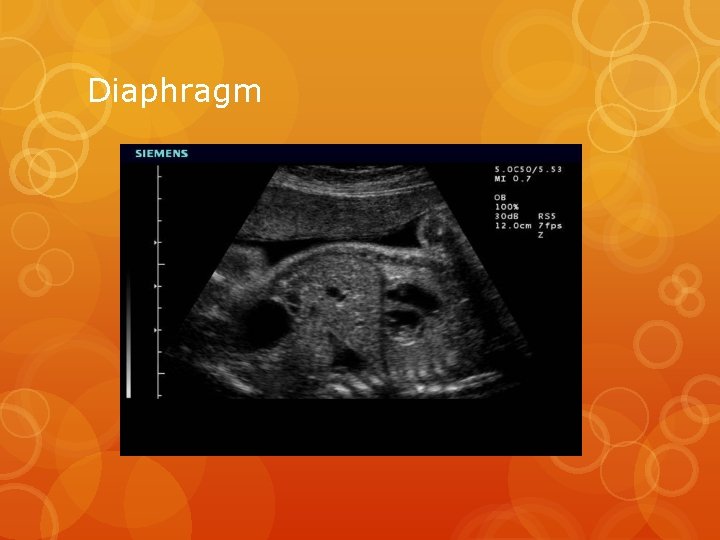 Diaphragm 