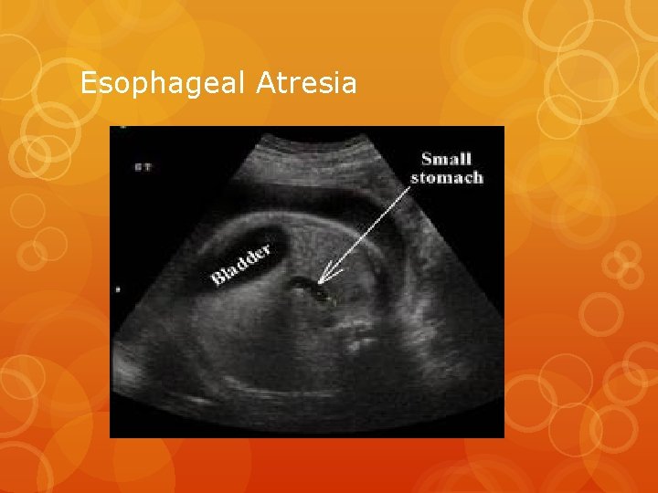 Esophageal Atresia 