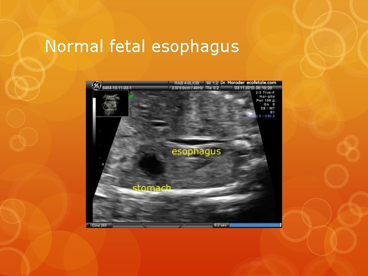 Normal fetal esophagus 