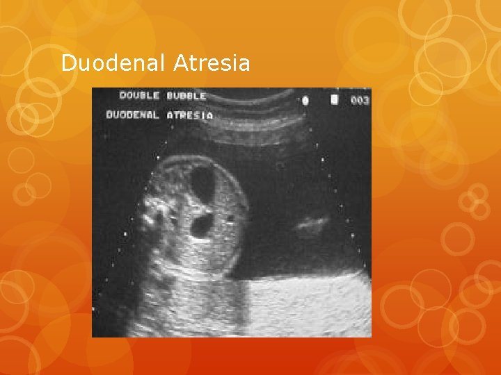 Duodenal Atresia 