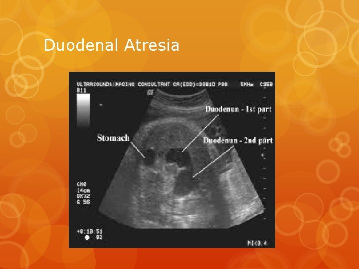 Duodenal Atresia 
