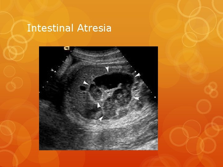 Intestinal Atresia 