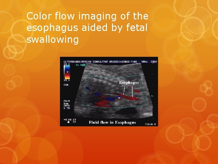Color flow imaging of the esophagus aided by fetal swallowing 