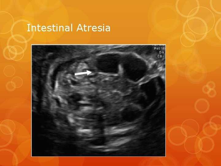 Intestinal Atresia 