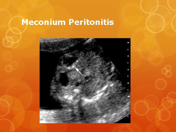 Meconium Peritonitis 