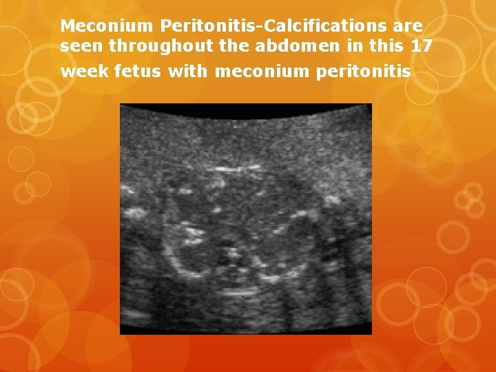 Meconium Peritonitis-Calcifications are seen throughout the abdomen in this 17 week fetus with meconium