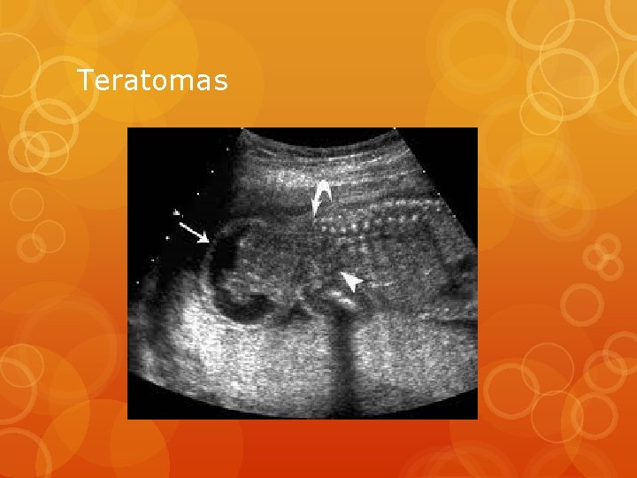 Teratomas 