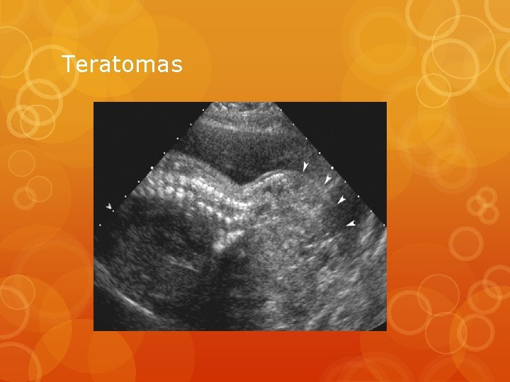 Teratomas 