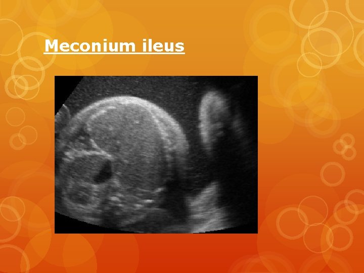 Meconium ileus 