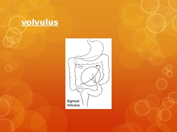 volvulus 