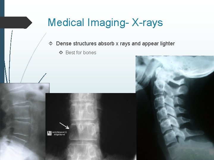 Medical Imaging- X-rays Dense structures absorb x rays and appear lighter Best for bones