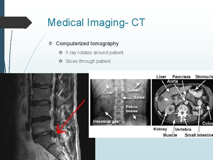 Medical Imaging- CT Computerized tomography X ray rotates around patient Slices through patient 