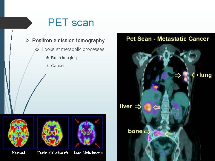 PET scan Positron emission tomography Looks at metabolic processes Brain imaging Cancer 