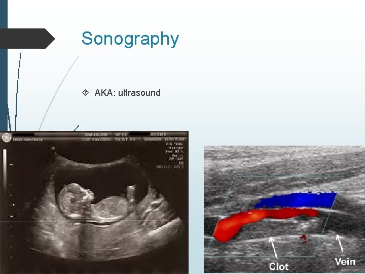 Sonography AKA: ultrasound 