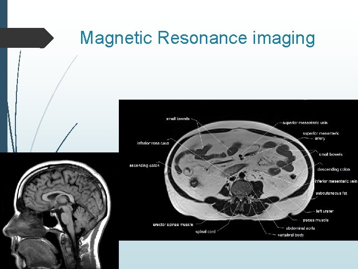 Magnetic Resonance imaging 