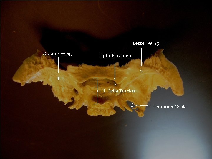 Lesser Wing Greater Wing Optic Foramen 5 4 3 1 Sella Turcica 2 Foramen Lesser Wing Greater Wing Optic Foramen 5 4 3 1 Sella Turcica 2 Foramen