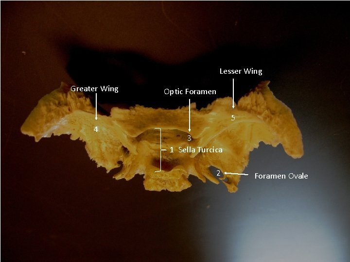 Lesser Wing Greater Wing Optic Foramen 5 4 3 1 Sella Turcica 2 Foramen