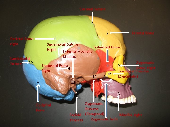 Coronal Suture 7 2 Parietal Bone right Frontal Bone 1 Squamosal Suture Sphenoid Bone Coronal Suture 7 2 Parietal Bone right Frontal Bone 1 Squamosal Suture Sphenoid Bone