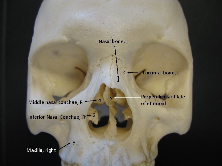 Nasal bone, L 3 Lacrimal bone, L 1 4 Middle nasal conchae, R Inferior Nasal bone, L 3 Lacrimal bone, L 1 4 Middle nasal conchae, R Inferior