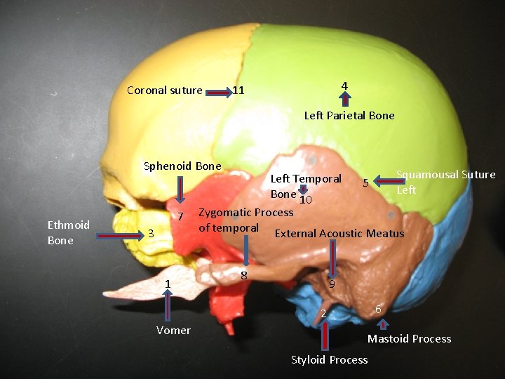 Coronal suture 4 11 Left Parietal Bone Sphenoid Bone Ethmoid Bone 7 3 1