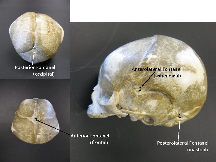 3 Posterior Fontanel (occipital) Anterolateral Fontanel (sphenoidal) 2 1 4 Anterior Fontanel (frontal) Posterolateral