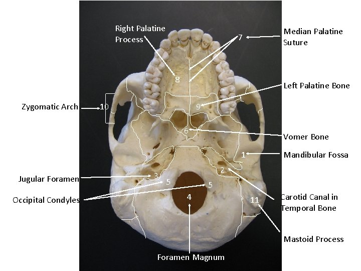 Right Palatine Process Median Palatine Suture 7 8 Zygomatic Arch Left Palatine Bone 10