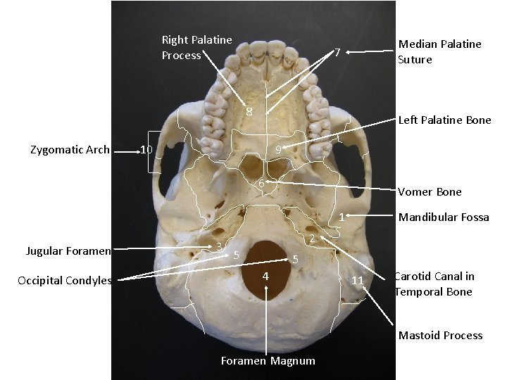 Right Palatine Process Median Palatine Suture 7 8 Zygomatic Arch Left Palatine Bone 10 Right Palatine Process Median Palatine Suture 7 8 Zygomatic Arch Left Palatine Bone 10