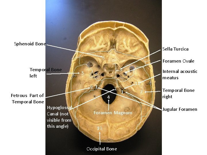 Sphenoid Bone Sella Turcica 6 Temporal Bone left Foramen Ovale 3 5 9 1