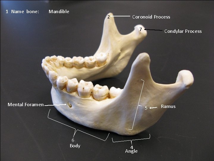 1 Name bone: Mandible 2 Coronoid Process 7 Mental Foramen 3 6 Body Condylar