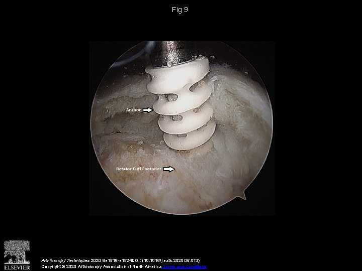 Fig 9 Arthroscopy Techniques 2020 9 e 1519 -e 1524 DOI: (10. 1016/j. eats.