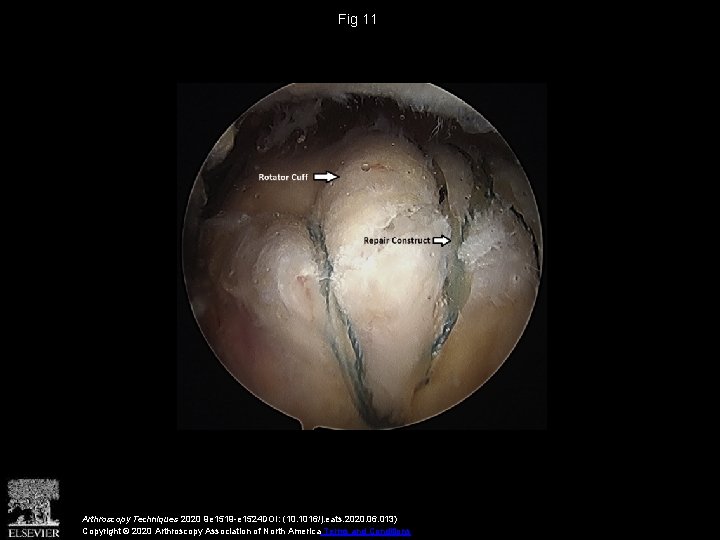 Fig 11 Arthroscopy Techniques 2020 9 e 1519 -e 1524 DOI: (10. 1016/j. eats.