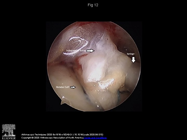 Fig 12 Arthroscopy Techniques 2020 9 e 1519 -e 1524 DOI: (10. 1016/j. eats.