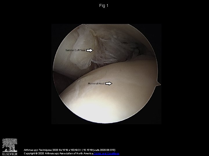 Fig 1 Arthroscopy Techniques 2020 9 e 1519 -e 1524 DOI: (10. 1016/j. eats.
