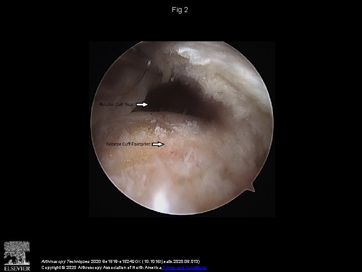 Fig 2 Arthroscopy Techniques 2020 9 e 1519 -e 1524 DOI: (10. 1016/j. eats.