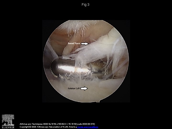Fig 3 Arthroscopy Techniques 2020 9 e 1519 -e 1524 DOI: (10. 1016/j. eats.
